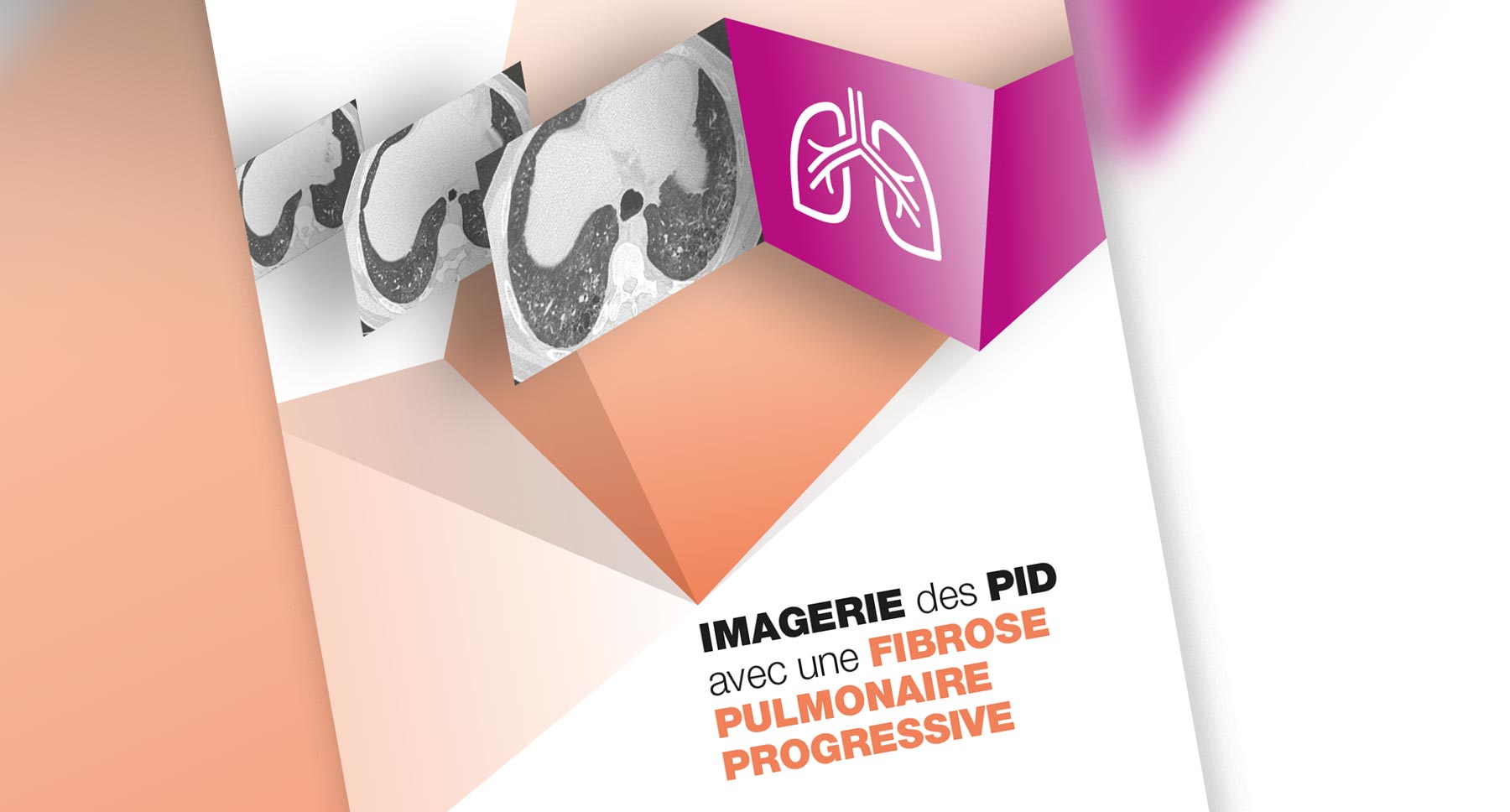 Focus sur l'imagerie des PID avec une FPP