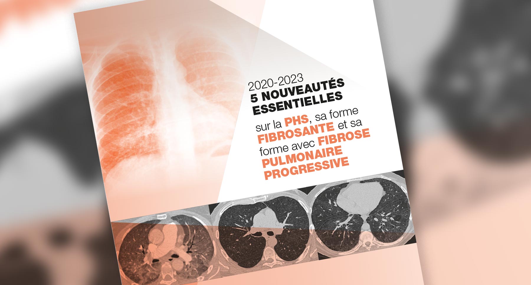 Nouveautés dans la Pneumopathie d'Hypersensibilité (PHS)