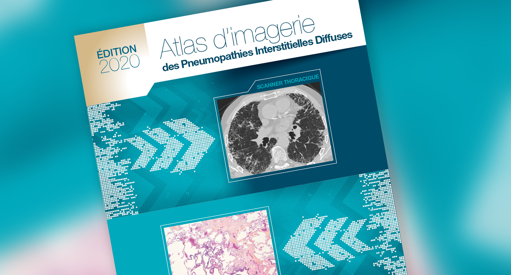 Atlas d'imagerie des Pneumopathies interstitielles Diffuses