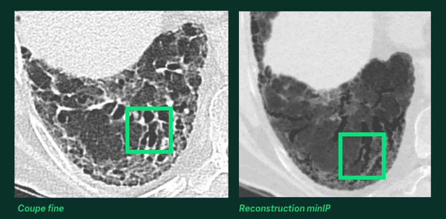 Lésions Pulmonaires - Bronchectasies - A