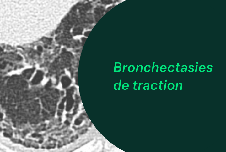 Lésions Pulmonaires - Bronchectasies