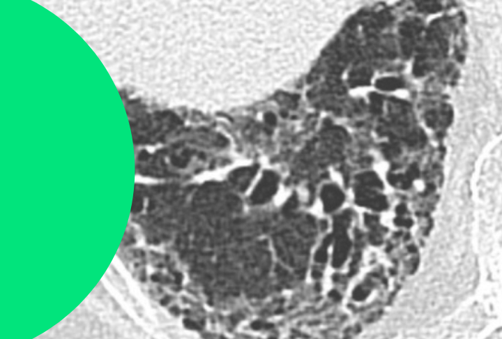 Lésions Pulmonaires - Bronchectasies