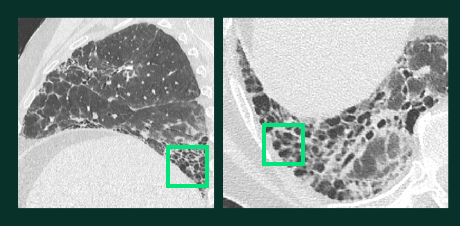 Lésions Pulmonaires - Rayon de miel - A