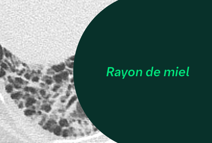 Lésions Pulmonaires - Rayon de miel