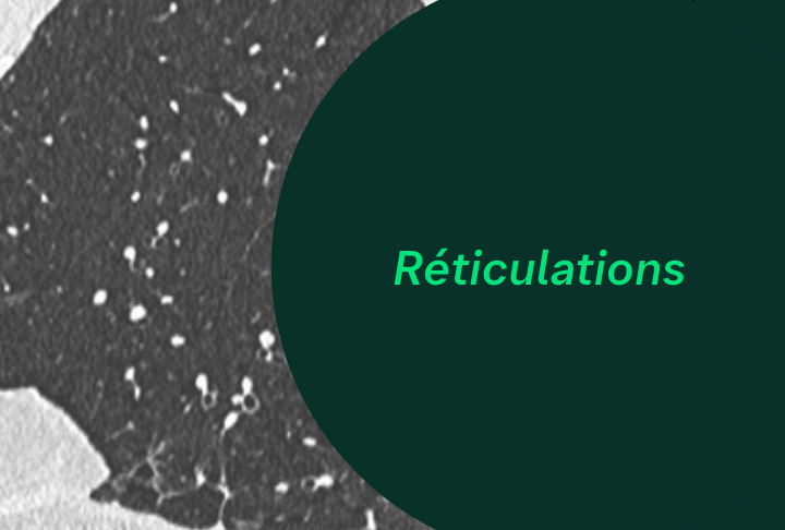 Lésions Pulmonaires - Réticulations