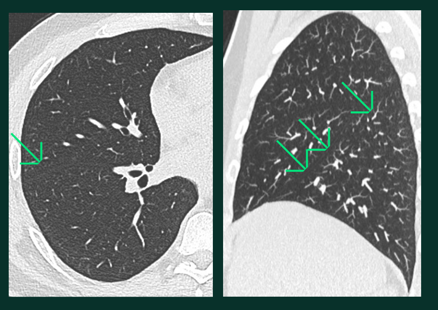Lésions Pulmonaires - perte - A