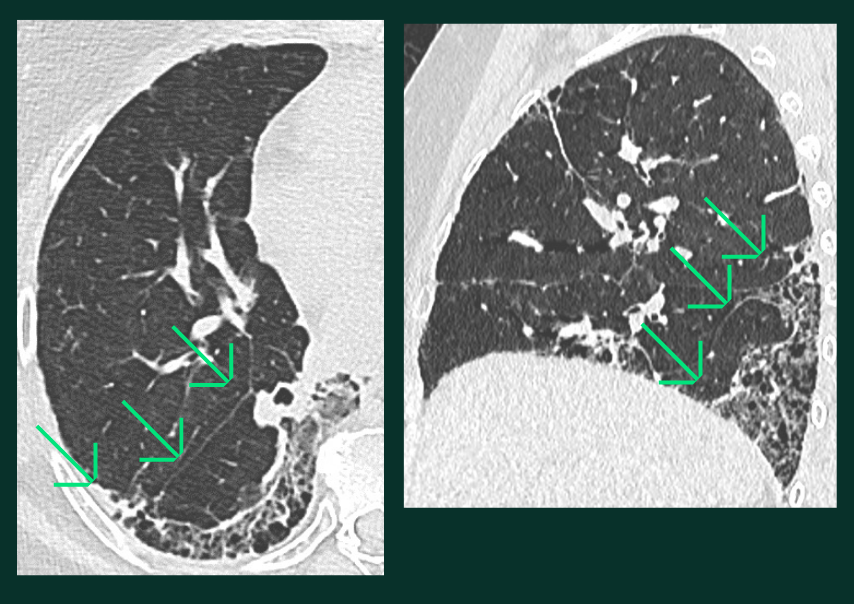 Lésions Pulmonaires - perte - B