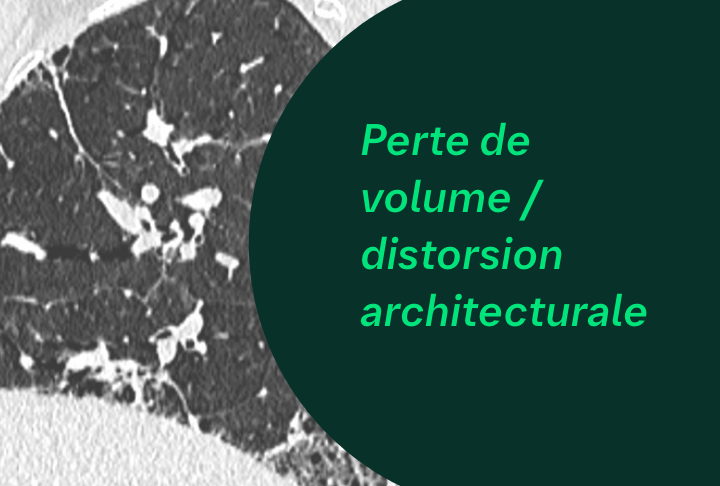 Lésions Pulmonaires - perte de volume