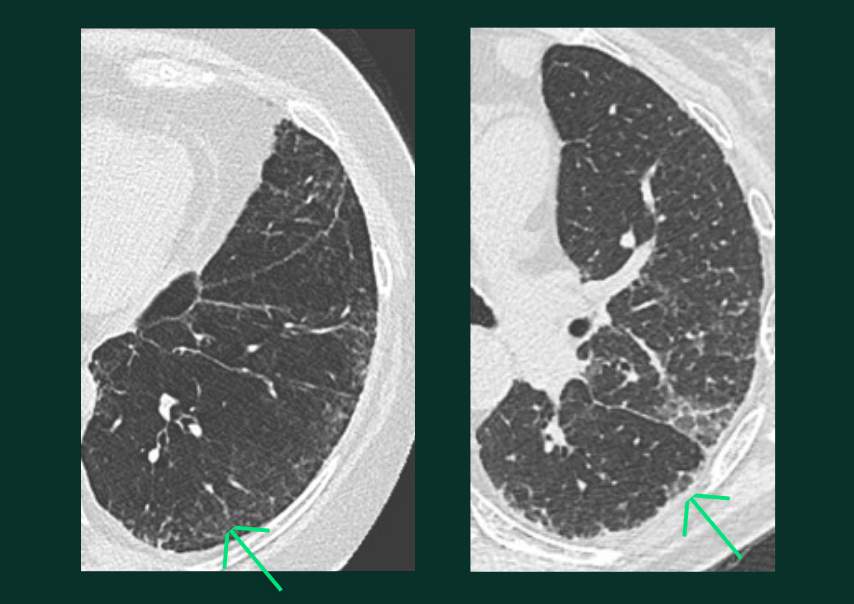 Lésions Pulmonaires - réticulations - C