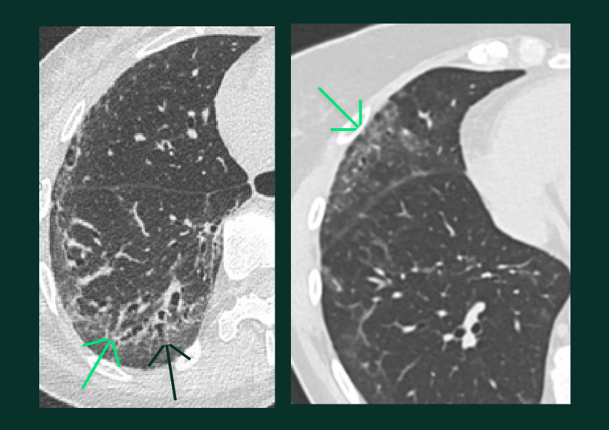 Lésions Pulmonaires - verre - A