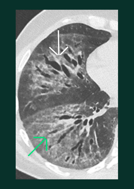 Lésions Pulmonaires - verre - B
