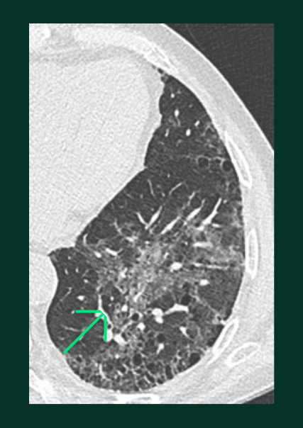 Lésions Pulmonaires - verre - C