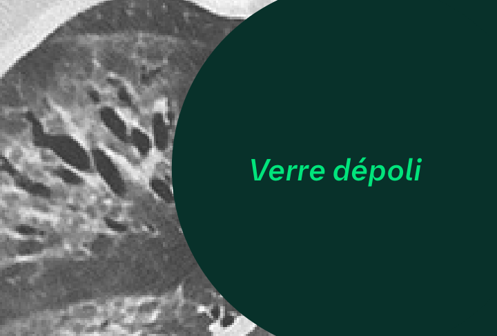 Lésions Pulmonaires - verre depoli