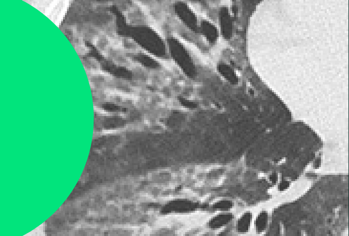 Lésions Pulmonaires - verre depoli